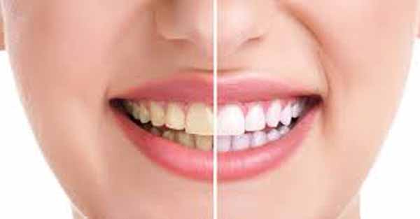 7 nguyên nhân làm răng bị ố vàng